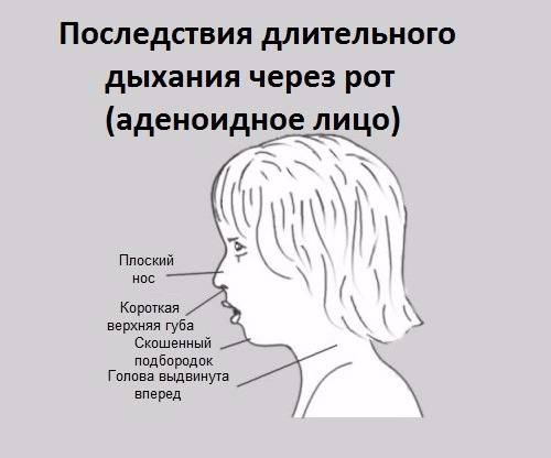 Лазеротерапия при аденоидах - наш опыт