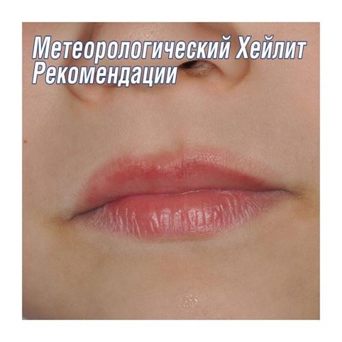 Заеды в уголках рта, причины и лечение