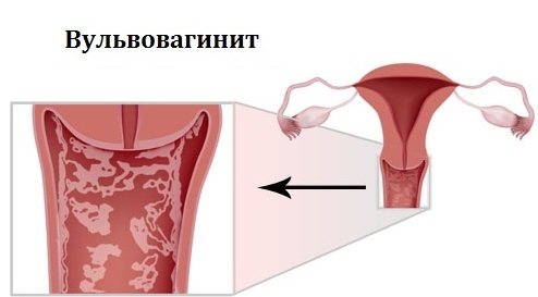 Вульвит у женщин – симптомы и лечение. кандидозный, аллергический, атрофический, хронический и острый вульвит
