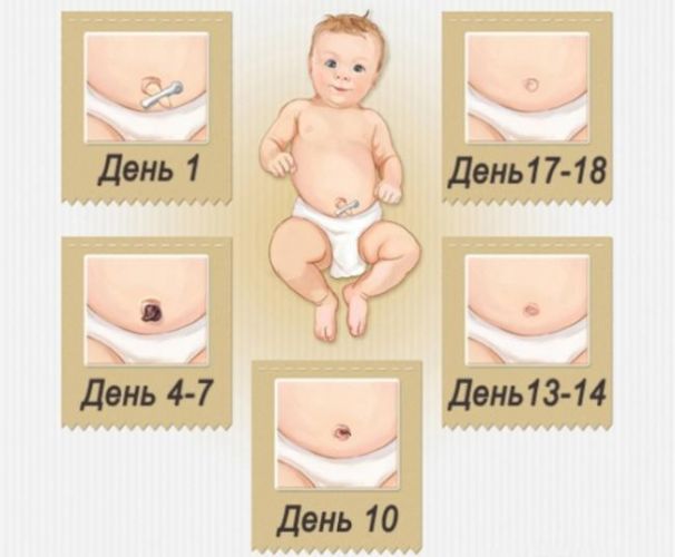 Кровит пупок у новорожденного!?