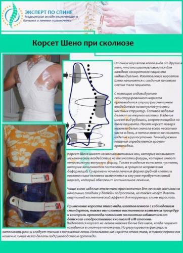 Как лечить сколиоз 2 степени у взрослых