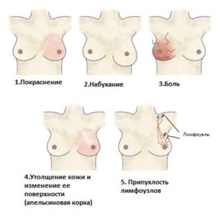 Симптомы мастита