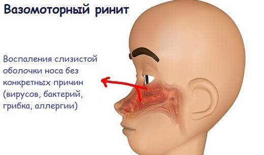 Как вылечить хронический вазомоторный ринит