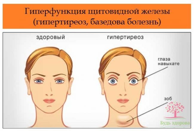 Психиатрические расстройства: щитовидная железа может быть причиной