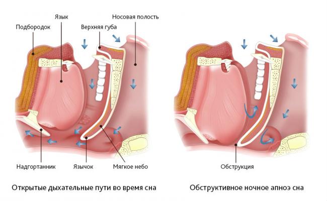 Синдром апноэ сна что это
