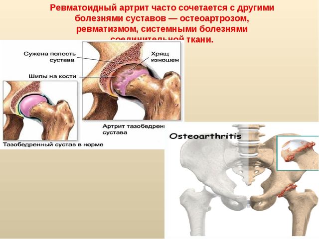 Как лечить остеоартрит коленного сустава?