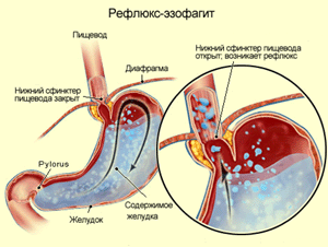 Гастроэзофагеальная рефлюксная болезнь (гэрб)