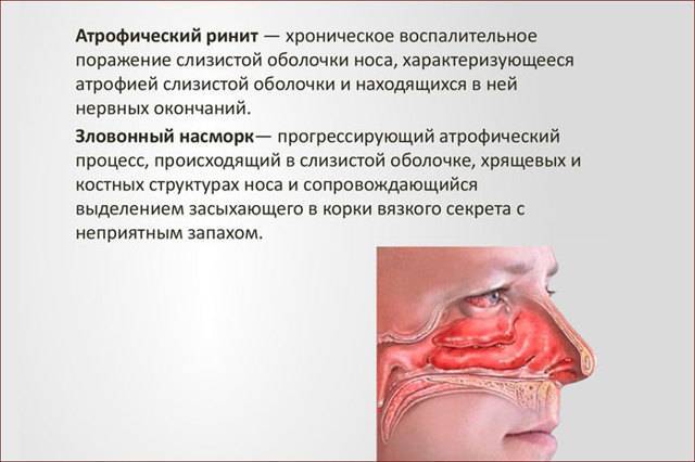 Корочки в носу у взрослых: причины, почему постоянно образуются, и их лечение