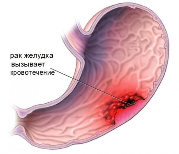 Опухоль: что это такое, виды, причины, симптомы и классификация