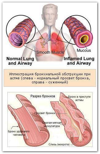 Профилактика бронхиальной астмы