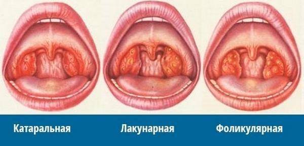Боль в горле при глотании с одной стороны и отдает в ухо лечение