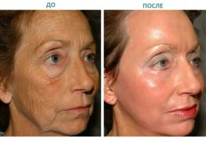 Ретиноевая мазь (retinoic ointment)
