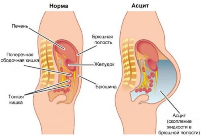 Диета при асците