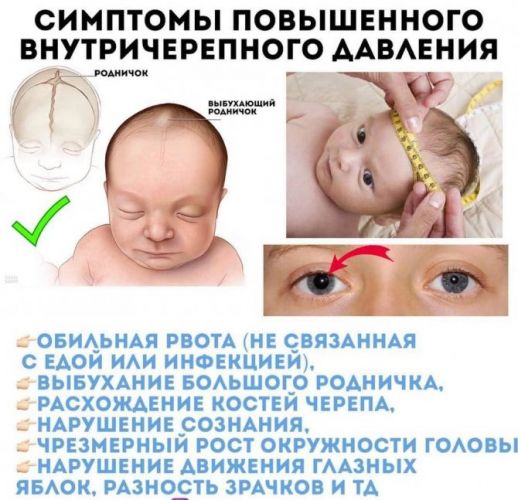 Повышенное внутричерепное давление у ребенка, грудничка