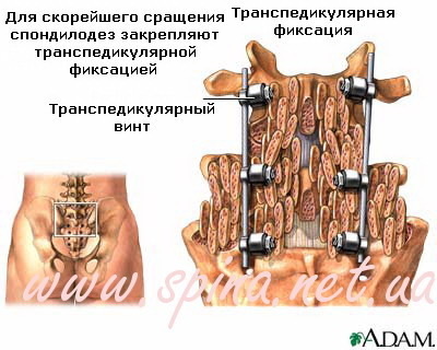 Хирургический спондилодез шейного отдела позвоночника