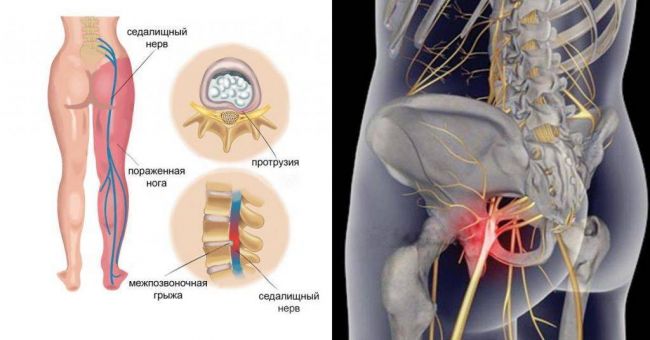 Реабилитация после удаления грыжи поясничного отдела позвоночника