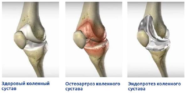 Повторное эндопротезирование искусственного сустава: как скоро понадобится?