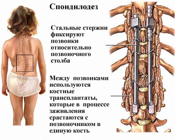 Межтеловой спондилодез при сколиозе