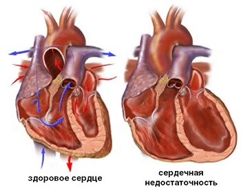 Кардиосклероз — большая медицинская энциклопедия