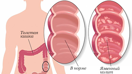 Диета при глистах и паразитах