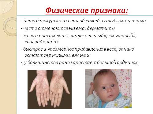 Фенилкетонурия у детей: признаки заболевания, лечение, клинические рекомендации