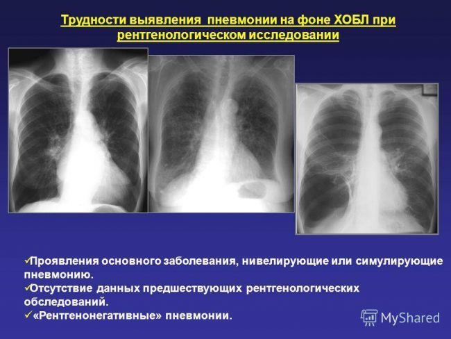 Диагностика пневмонии легких при помощи рентгена