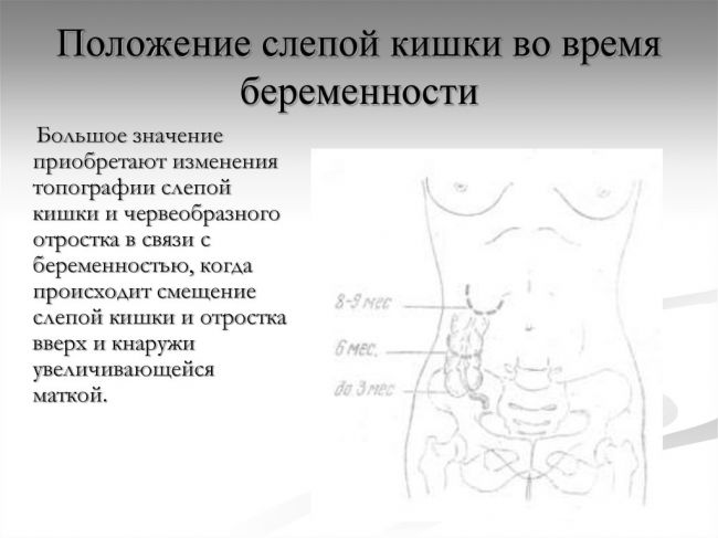 Аппендицит. причины, симптомы, диагностика и лечение.