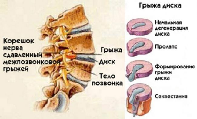 Парамедианная грыжа межпозвонкового диска позвоночника: отличия, симптомы, лечение