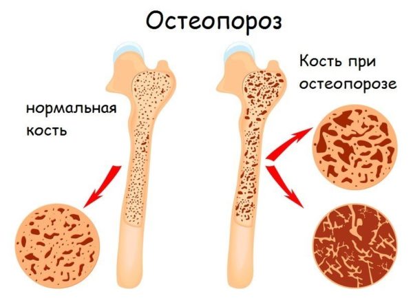 Компрессионный перелом позвоночника: что это такое, симптомы, лечение, последствия перелома позвонков