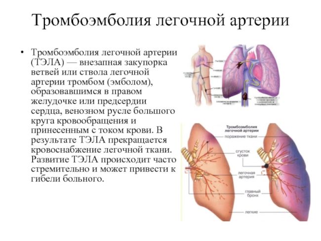 Признаки и лечение артериального тромбоза нижних конечностей