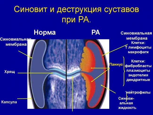 Рекомендации при артрите