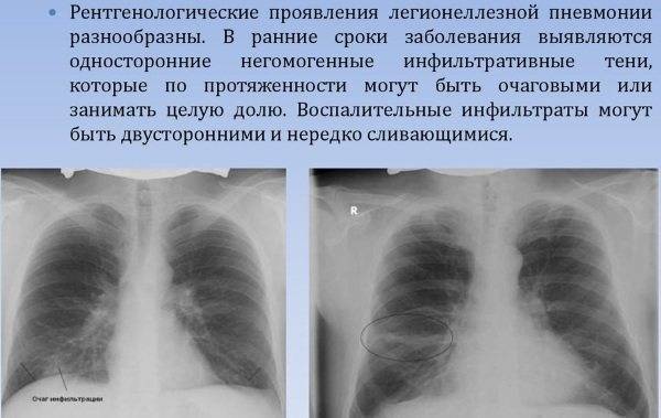 Пневмония без температуры: что это значит?