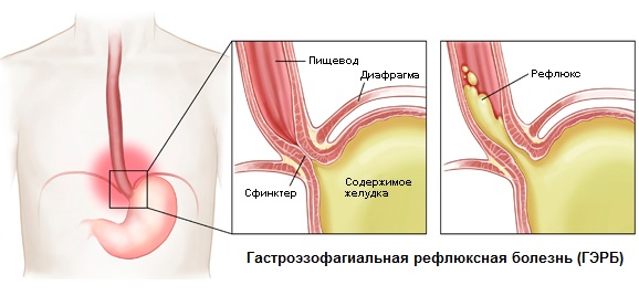 Рефлюксная болезнь желудка: симптомы, лечение