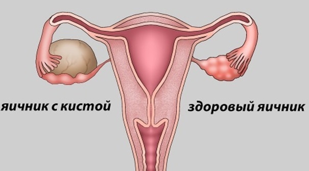 Киста яичника: причины, классификация, основные симптомы и отличительные признаки отдельных форм, диагностические мероприятия, консервативные и хирургические методы лечения..