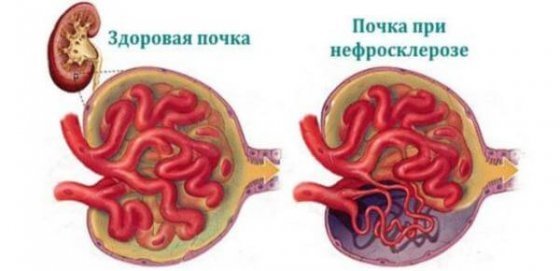 Нефросклероз или сморщенная почка: виды заболевания, диагностика и лечение у взрослых и детей, прогноз жизни и другие аспекты болезни