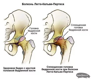 Болезнь пертеса (легга кальве пертеса, асептический некроз головки бедренной кости) у детей – симптомы, лечение, стадии