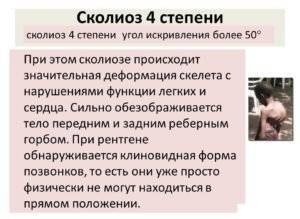 Как определить сколиоз на ранней стадии
