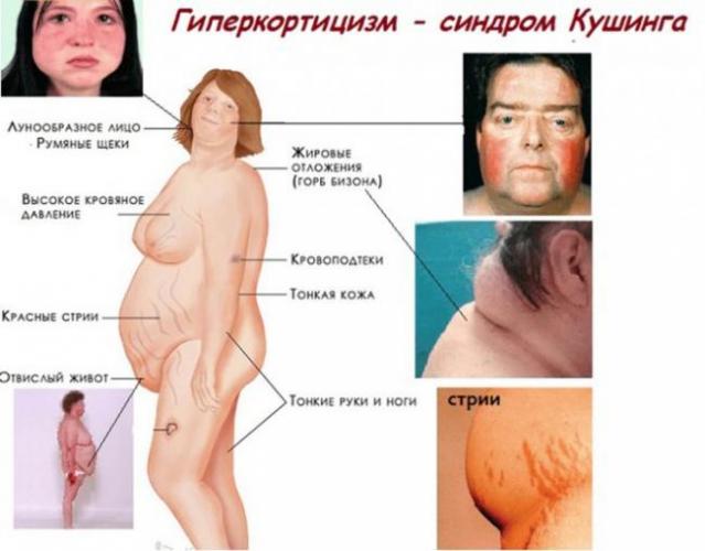 Гиперкортицизм (болезнь иценко-кушинга): причины, симптомы, лечение