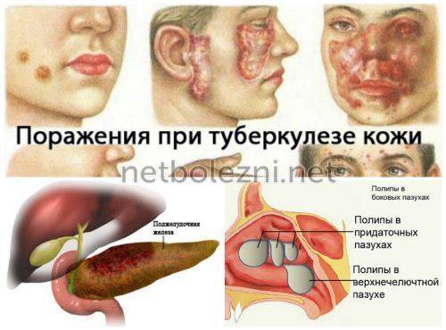 Лечение и заживление мокнущих ран