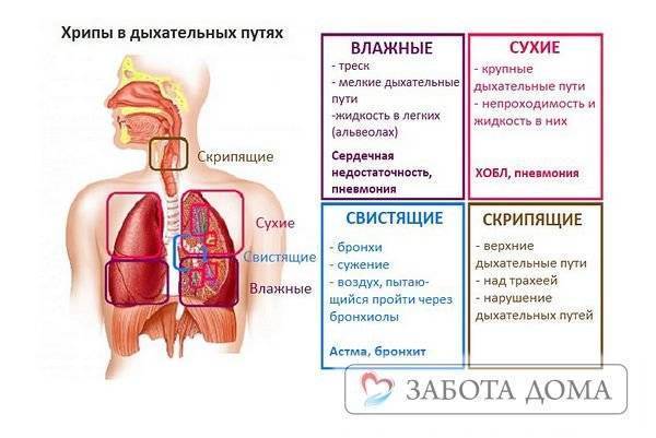 Пневмония у лежачих больных: причины, симптомы, лечение