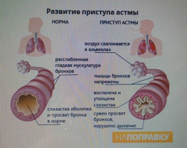 Что делать при приступе астмы: меры первой помощи