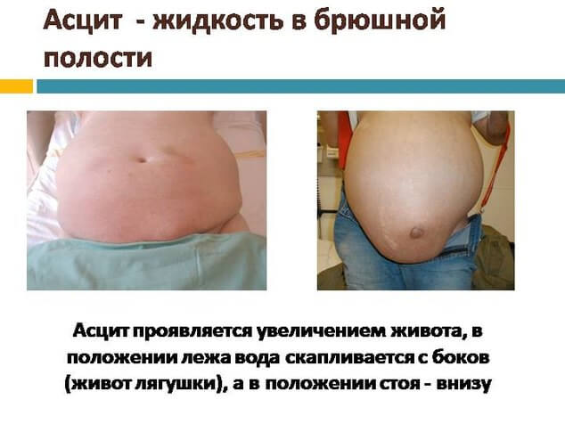 Почему развивается асцит, как его распознать и вылечить