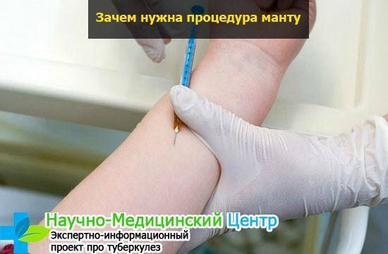Проба манту на туберкулез и ее нормы у ребенка после введения вакцины