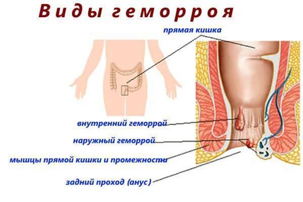 Свечи Релиф инструкция по применению и отзывы покупателей