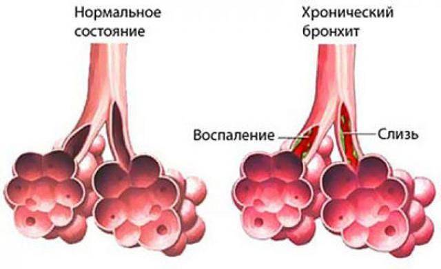 Что лучше: амбробене или коделак?