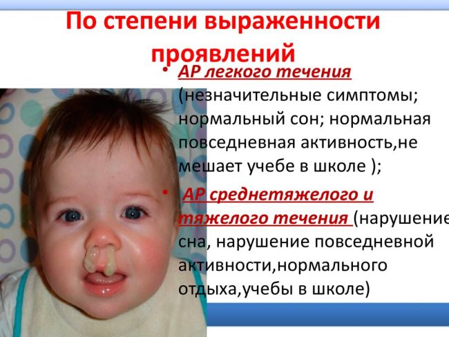 Аллергический ринит у ребенка: симптомы и лечение, как отличить от обычного насморка
