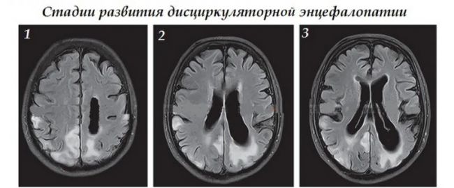 Как проявляется энцефалопатия? что это такое и как ее лечить?