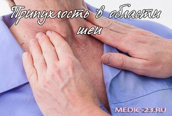 Припухлость в области мышц шеи