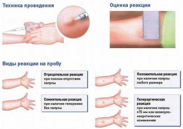 Что делать, если у ребенка большая и красная манту: почему бывает плохая реакция и гиперемия?