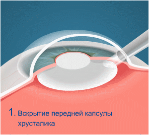 Как вести себя после операции по удалению катаракты глаза (замене хрусталика на иол)